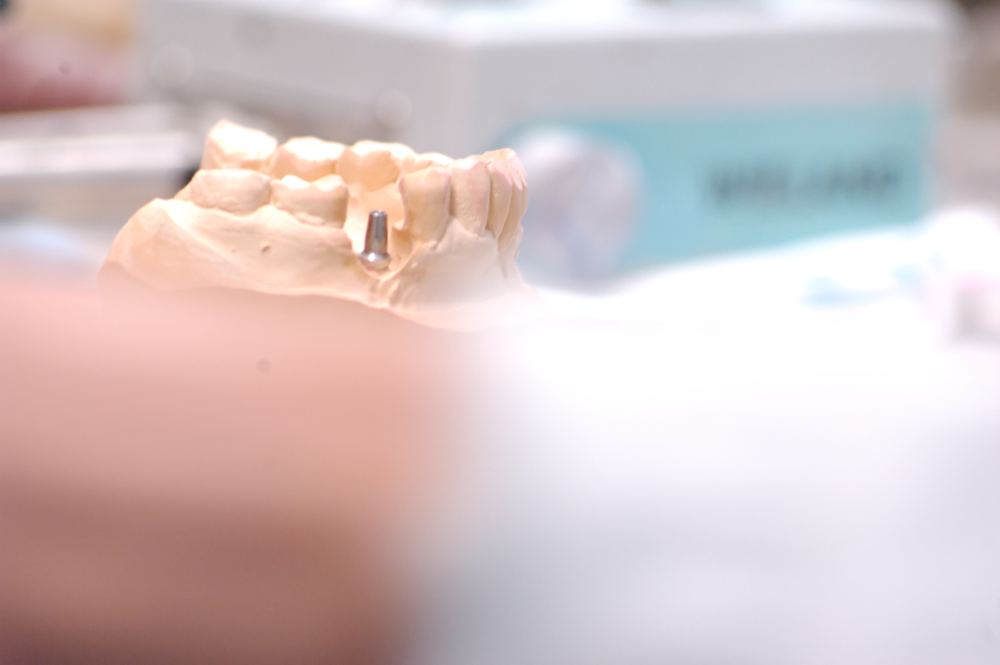 Implantatmodell